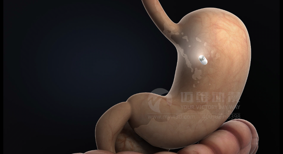 醫(yī)學(xué)醫(yī)療三維動畫 醫(yī)學(xué)醫(yī)療三維動畫