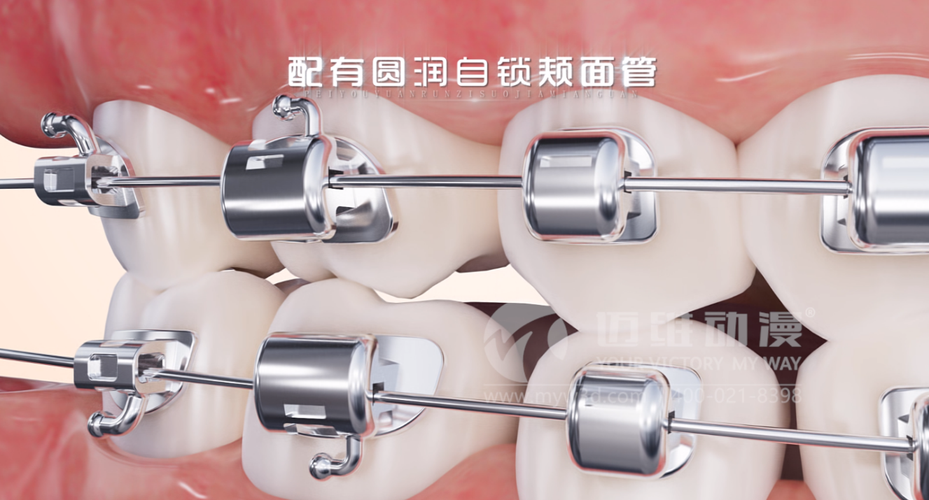 華文7D自鎖托槽產(chǎn)品展示三維動畫(圖1) 華文7D自鎖托槽產(chǎn)品展示三維動畫(圖1)