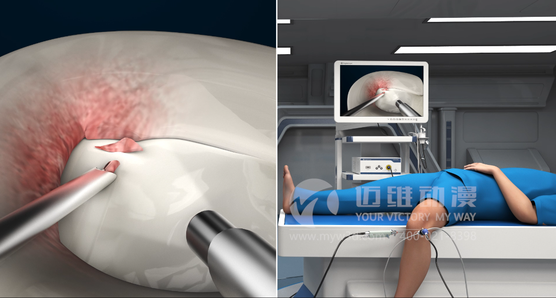 醫(yī)學醫(yī)療行業(yè)為什么青睞于三維動畫？(圖4)